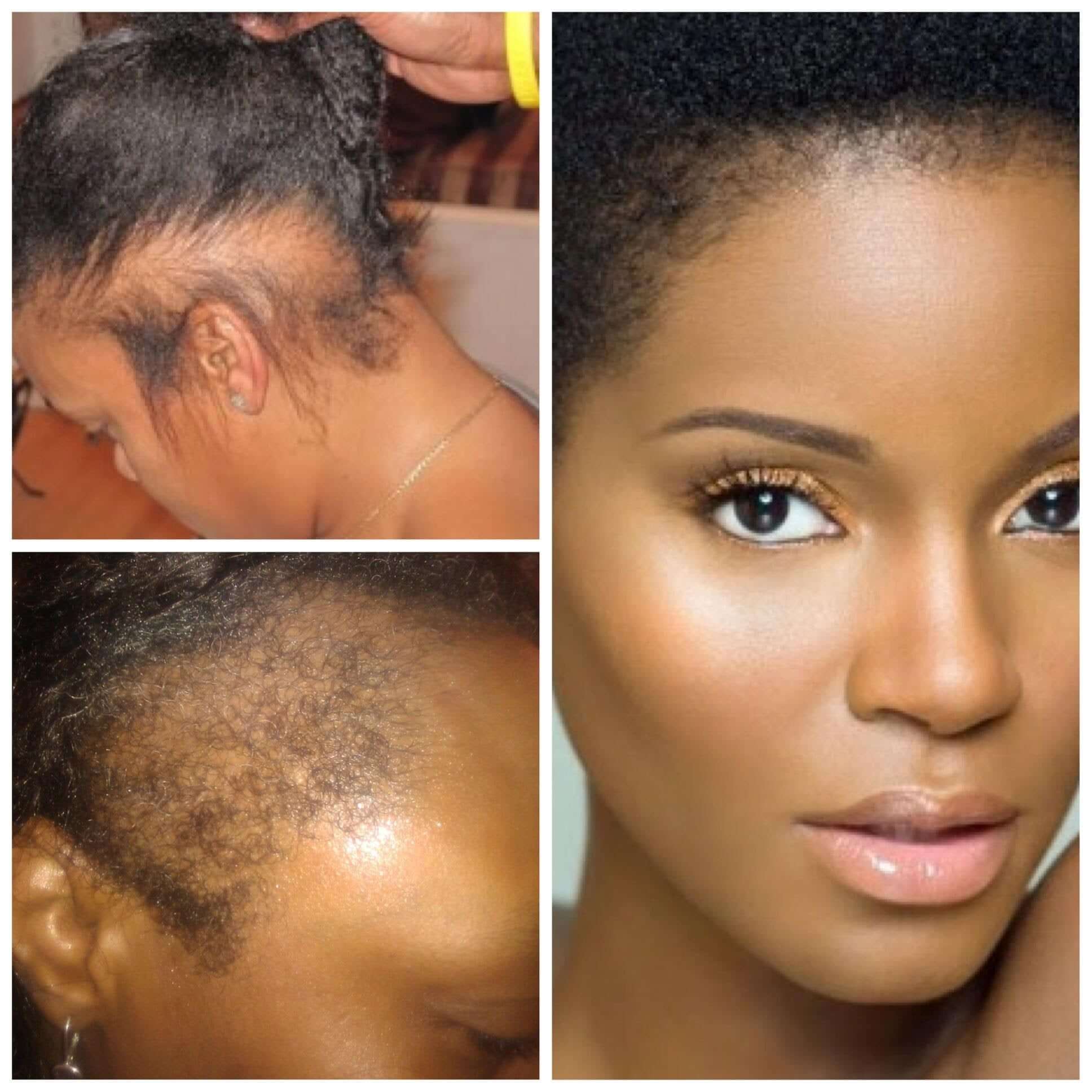 alopécie de traction, perte de cheveu, baby hair endommagé, cheveux fragilisés, cheveu afro