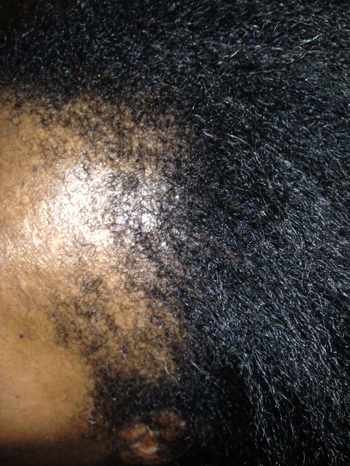 Comprendre l'Alopecie de Traction : Causes, Prévention et Solutions Efficaces